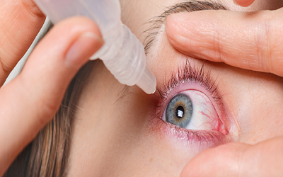 روش های درمان خانگی عفونت چشم!